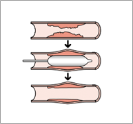 動脈硬化に対するバルーン拡張術とステント留置術とは