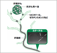 肝臓がんに対する動脈塞栓術