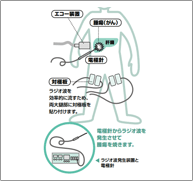 肝臓がんに対するラジオ波凝固療法