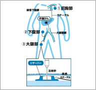 動注リザーバー療法をご存知ですか？