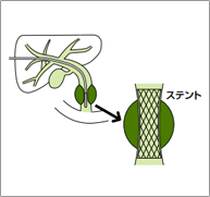 黄疸に対する胆管ステント