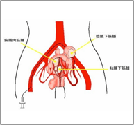 子宮筋腫に対する子宮動脈塞栓術