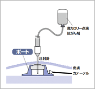 静脈ポート